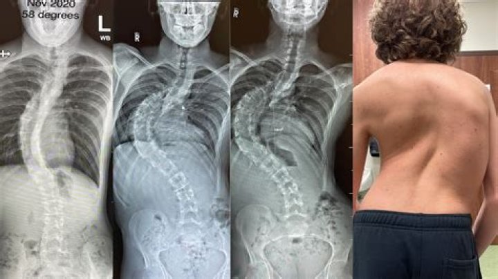 Can you get a scholarship for having scoliosis?