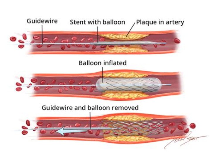 Can you undo Cosigning?